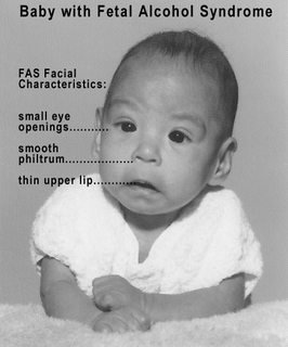 Baby with Fetal Alcohol Syndrome